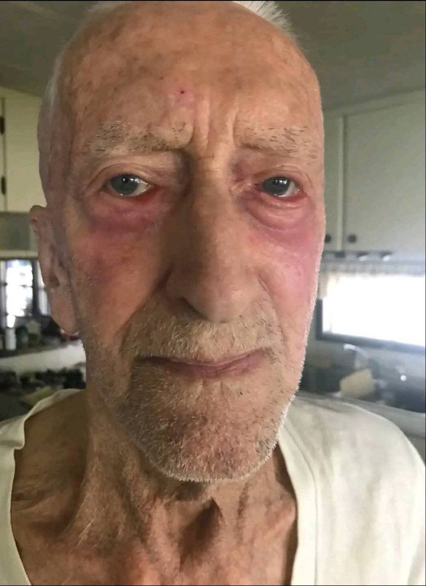 docburstein's tweet photo. IVERMECTIN Topical Cream Testimonial - 88 year old Alberta farmer with  skin Cancer has 4 tubes of Ivermectin paste sent to him by his son

More and more Topical Ivermectin testimonials are starting to come in...

88 year old farmer in Alberta was diagnosed with skin cancer https://t.co/mimPVEQ8hT
