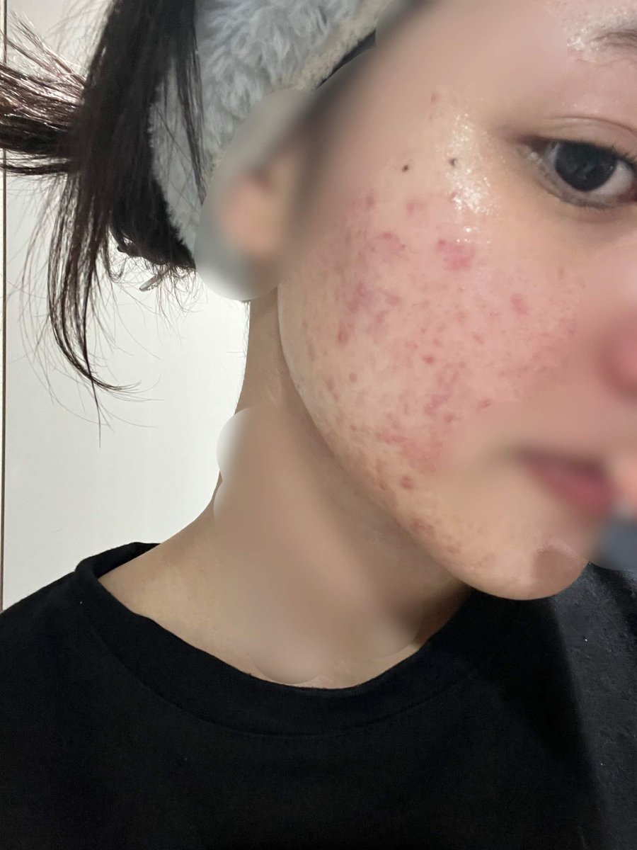 TAB_c001's tweet photo. 汚肌注意⚠️

荒れに対して何しても収まらなかったニキビ体質
イソトレチノイン初めて2ヶ月
こんなにも劇的に変わりました…
まだ乾燥はありますが、悩んでいた摩擦やメイクでの肌荒れることは無くなってます…🥹✨
(※個人差あります) https://t.co/hxG6VXGOPk