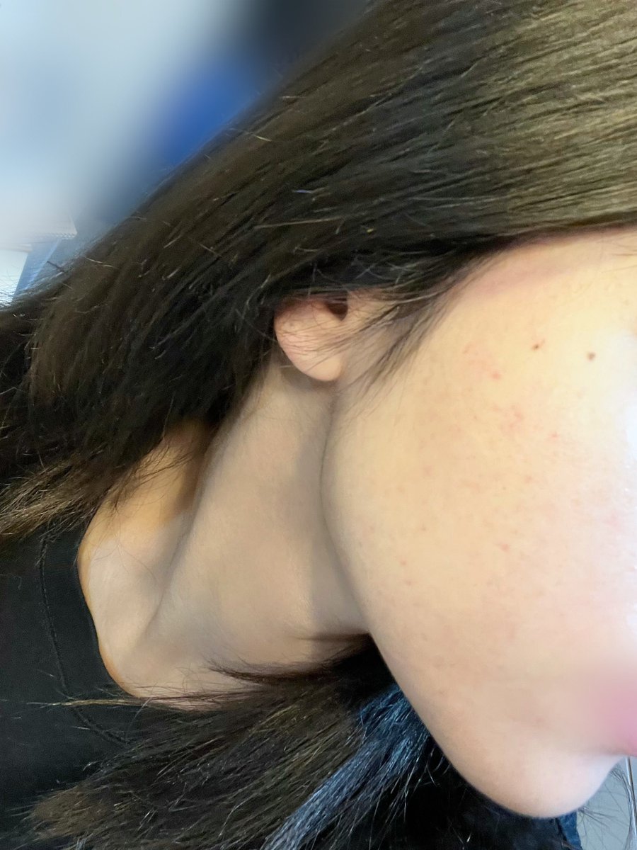 TAB_c001's tweet photo. 汚肌注意⚠️

荒れに対して何しても収まらなかったニキビ体質
イソトレチノイン初めて2ヶ月
こんなにも劇的に変わりました…
まだ乾燥はありますが、悩んでいた摩擦やメイクでの肌荒れることは無くなってます…🥹✨
(※個人差あります) https://t.co/hxG6VXGOPk