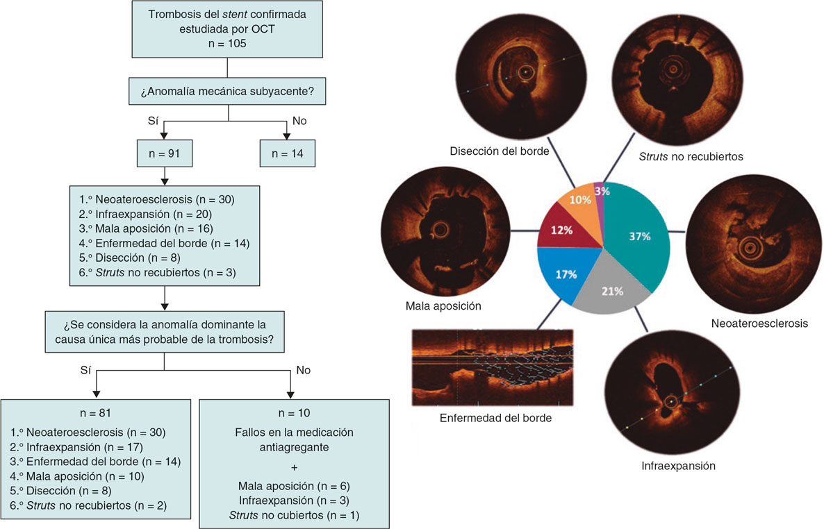 RevEspCardiol's tweet photo. Tomografía de coherencia óptica en el diagnóstico y el tratamiento de la trombosis del stent #recintervcardiol @paulantun @CCuesta2 @fer_iver @teresabastante @Guimacardio @David_delVal_ @AfMarschall @moriscesar @PabloAvanzas @shci_sec https://t.co/vACGRhFRjl https://t.co/Fi8BBbAzG0