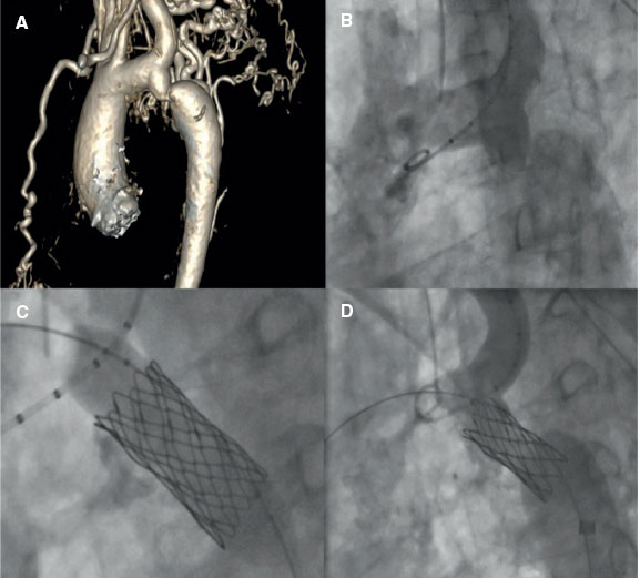RevEspCardiol's tweet photo. Transcatheter treatment of aortic coarctation #recintervcardiol  @VictorArevalos @Anthony18694706 @a_rubi_5 @Raquel_lunalop @CIgorMorr @pedro_cepas @lsanchisruiz @RiSanz2020 @AnderRegueiro @sbrugaletta @ejfu0209 @freixa_xavier @shci_sec https://t.co/43PUbNf8Rl https://t.co/h3Pv5BdcU9