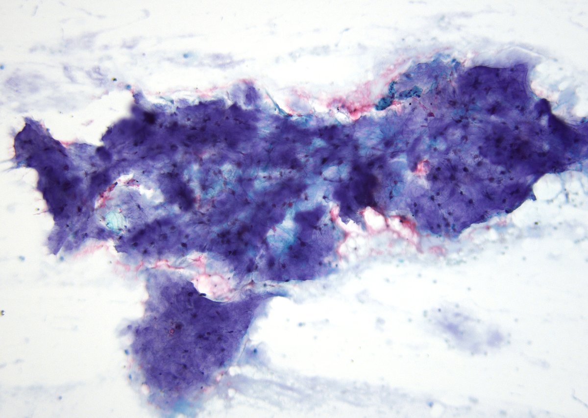 sza_jhcyto's tweet photo. Pleomorphic adenomas can still look pretty on Pap stain, a case from this morning. (Parotid, FNA) https://t.co/nlVlzyxHl8