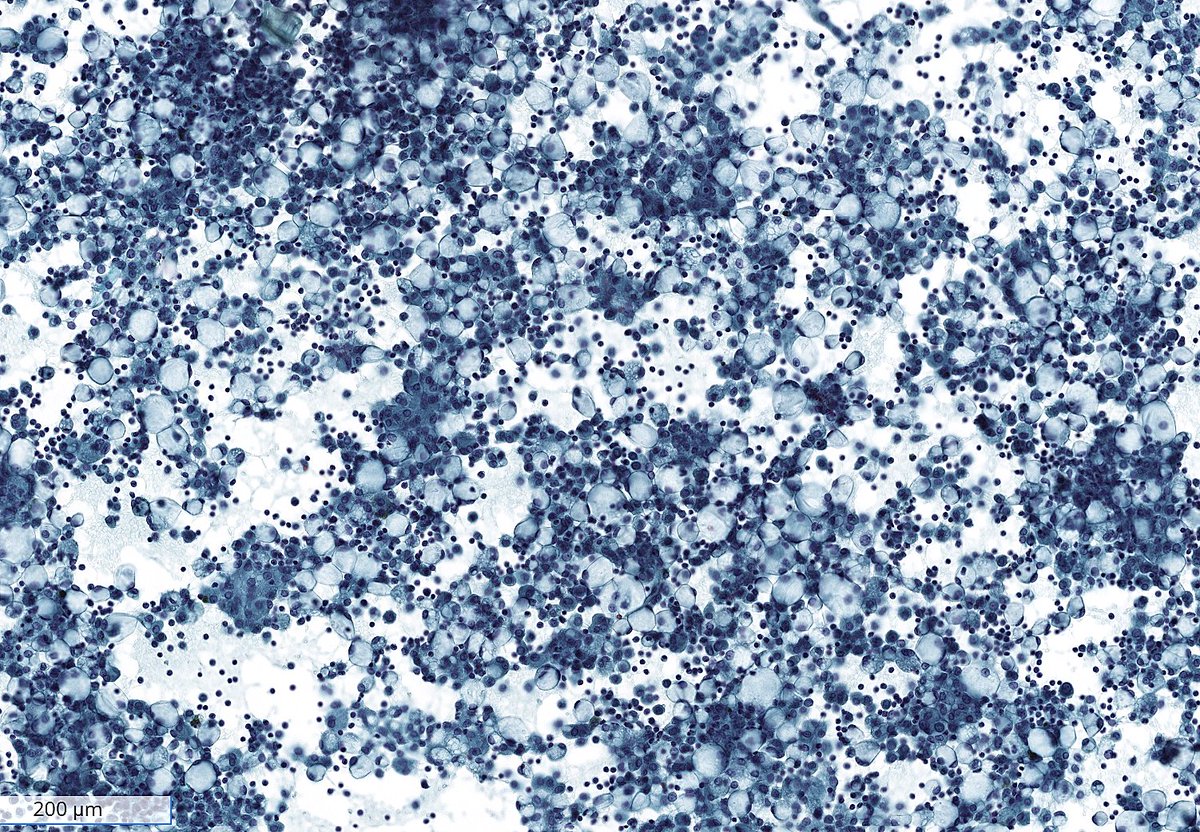sza_jhcyto's tweet photo. “Pseudo–signet ring cells in ascitic fluid: a deceptive look that can lead you straight to the wrong diagnosis.”
Hydropic degeneration is known to occur in histiocytes and mesothelial cells.
(Cytospin preps) https://t.co/1KapODObbz