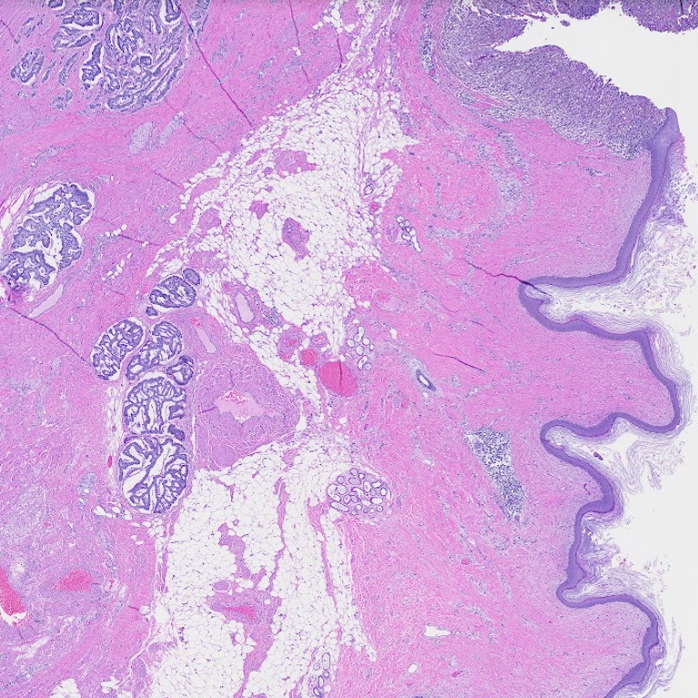 NYUGSOMpathres's tweet photo. A well-differentiated neuroendocrine tumor arising from a mature cystic teratoma! Tumor cells are diffusely positive for synaptophysin and CAM5.2, weakly positive for INSM1, and negative for chromogranin A. 🔬🔬🔬 #pathtwitter #path2path #pathology https://t.co/mcfePAnBbA