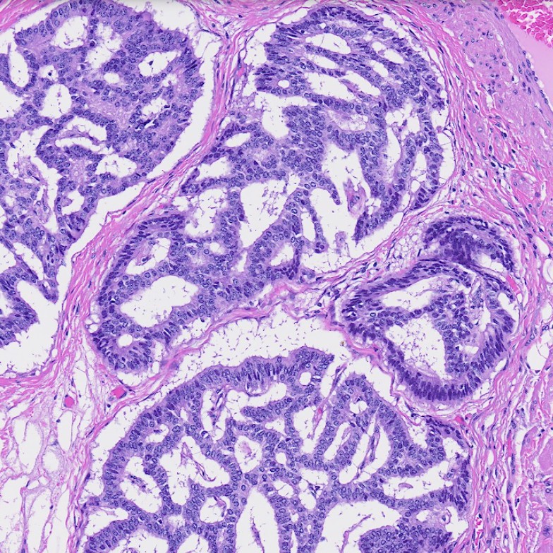 NYUGSOMpathres's tweet photo. A well-differentiated neuroendocrine tumor arising from a mature cystic teratoma! Tumor cells are diffusely positive for synaptophysin and CAM5.2, weakly positive for INSM1, and negative for chromogranin A. 🔬🔬🔬 #pathtwitter #path2path #pathology https://t.co/mcfePAnBbA