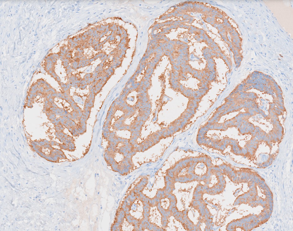NYUGSOMpathres's tweet photo. A well-differentiated neuroendocrine tumor arising from a mature cystic teratoma! Tumor cells are diffusely positive for synaptophysin and CAM5.2, weakly positive for INSM1, and negative for chromogranin A. 🔬🔬🔬 #pathtwitter #path2path #pathology https://t.co/mcfePAnBbA