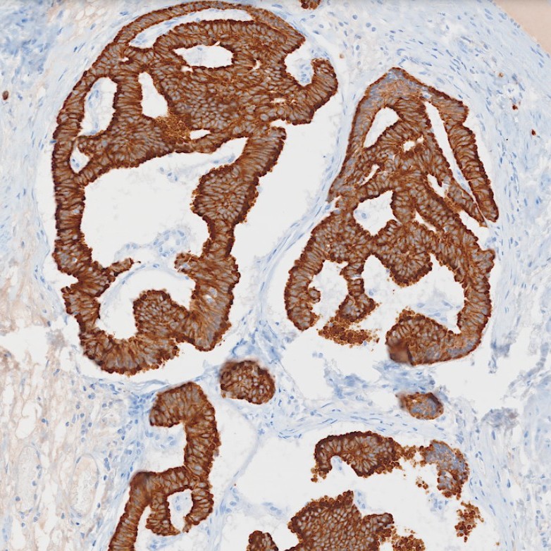 NYUGSOMpathres's tweet photo. A well-differentiated neuroendocrine tumor arising from a mature cystic teratoma! Tumor cells are diffusely positive for synaptophysin and CAM5.2, weakly positive for INSM1, and negative for chromogranin A. 🔬🔬🔬 #pathtwitter #path2path #pathology https://t.co/mcfePAnBbA