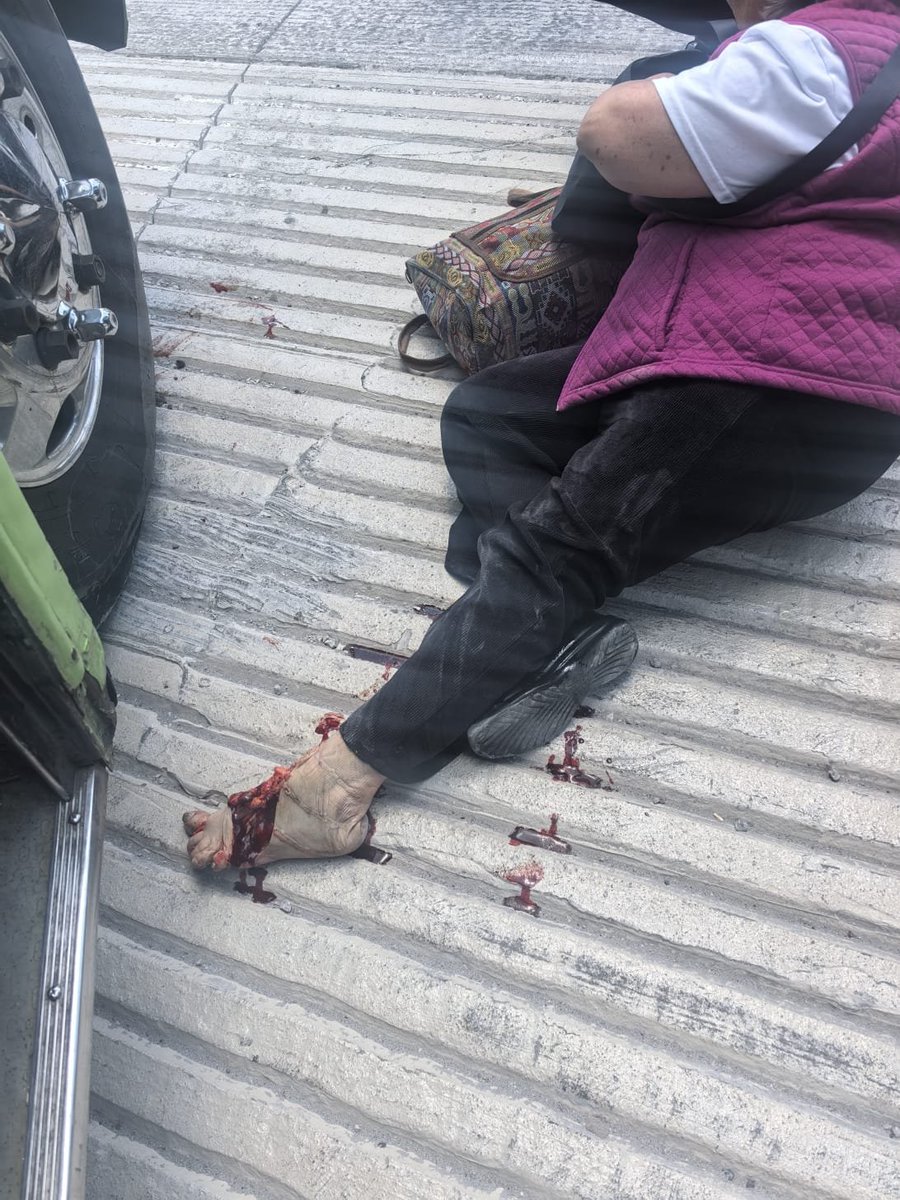 halcon_ulises's tweet photo. Fractura expuesta y posible amputacion, lo ocasionó un camión de la ruta 18 en indios verdes y su seguro que es de @Banorte_mx no se quiere hacer responsable #ayuda @GobiernoMX @ClaraBrugadaM @Azteca @Televisa @condusef https://t.co/GNUs3E8OD3