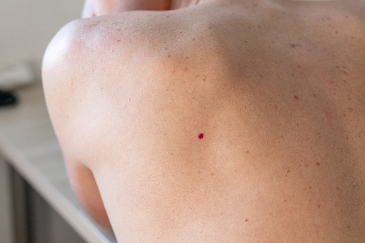 Practical_Derm's tweet photo. 🔬🔴 CHERRY ANGIOMAS AND NF1: New research in JAMA Dermatology suggests cherry angiomas may represent a previously underrecognized vascular manifestation of neurofibromatosis type 1 (NF1) ➡️ https://t.co/rklKi5fwUy #Dermatology #NF1 #Neurofibromatosis #DermResearch #SkinScience #MedicalResearch