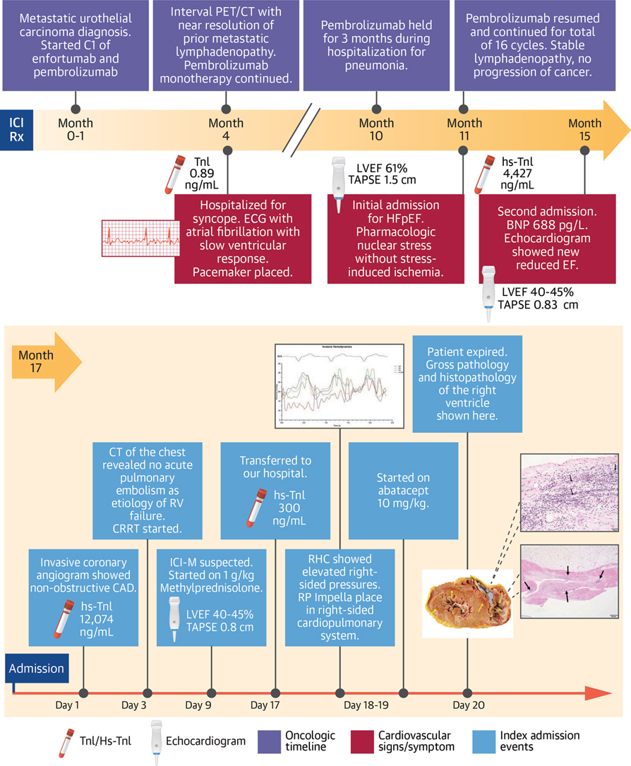 JACCJournals's tweet photo. ICI #myocarditis can present late &amp; atypically. Biventricular ICI-M w/ predominant RV failure 17 months after pembrolizumab, a reminder to maintain long-term vigilance for #cardiotoxicity beyond the early Tx period. https://t.co/rtzL58baJV

#JACCCardioOnc @datsunian @MichaelR21 https://t.co/2Za2lQANcO