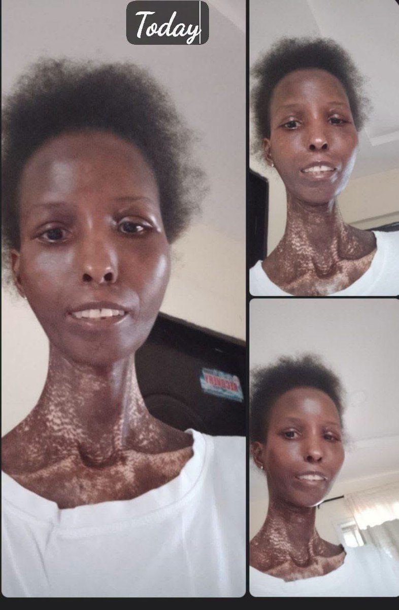 Nicholedietco's tweet photo. AUGUSTA OF TODAY 

This year makes it my 4th year of adopting and bringing her to Abuja and am grateful to God for honoring my faith in him.
1. Now standing
2. Now walking.
3. Now sitting straight
4. Added weight
5. Menses which ceased 7 years ago, when this ailment came up, returned on starting her healing program with Ndcl, 4 years ago and never ceased for even a month, eversince.
6. Now washes her own clothes, sweeps, washes her plates, cooks her foods, moves to neighboring shops and mini marts to buy food items.
7. Sores that were all over her body, emitting blood and pus, healed
8. Tears by her lip sides, healed
God has done a whole lot in 4 years, for those of us who have been following her story from day 1.
We had one challenge, which was homogenising her skin pigments and returning her complexion ( her skin was mostly pure white ).
The revelation came in January and 'boom', we gained a breakthrough. 
My prayer is thst, we bring back a perfect anf more beautiful Augusta in no time, because, i still got lots of plans for my baby..

N.B: The before picture is of 2 years ago, not before she started her healing program, please. She is far more improved there. We chose that picture to compare her skin of 2years ago and today.