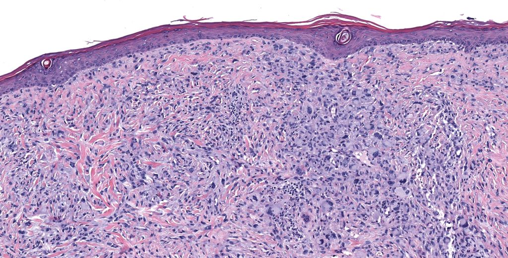 JMGardnerMD's tweet photo. 80 M scalp. Negative: SOX-10, p40, CK5, desmin, ERG.
Your topline diagnosis? Any comment you'd add?
Answer ✅ https://t.co/2VXmiLFq49
Digital slide: https://t.co/6vt2PD8wYQ.
Sample #pathology report: https://t.co/ppcxbjrX6O
#pathTwitter #dermpath #BSTpath #dermtwitter https://t.co/R5rR91ulUf