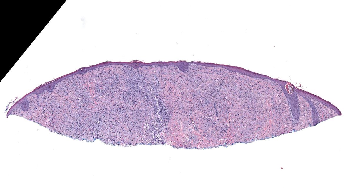 JMGardnerMD's tweet photo. 80 M scalp. Negative: SOX-10, p40, CK5, desmin, ERG.
Your topline diagnosis? Any comment you'd add?
Answer ✅ https://t.co/2VXmiLFq49
Digital slide: https://t.co/6vt2PD8wYQ.
Sample #pathology report: https://t.co/ppcxbjrX6O
#pathTwitter #dermpath #BSTpath #dermtwitter https://t.co/R5rR91ulUf