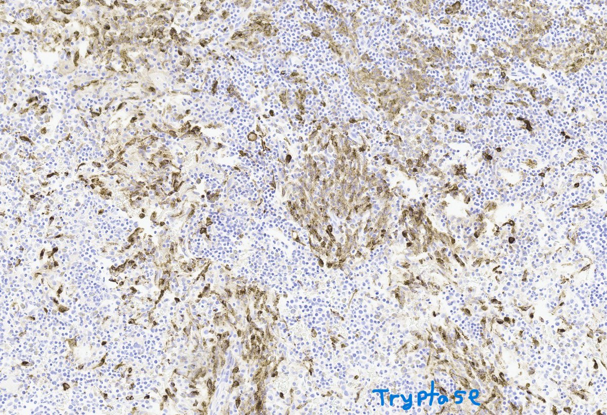 MeredithKHerman's tweet photo. Something’s brewing in the bone marrow… 
Don’t Tryp on these mast cells! 

A spindling review of systemic mastocytosis:

🚨Atypical= Spindled
🔴Cluster > 15 cells
🦴Para trabecular/perivascular
🧪CD2+ CD25+ Tryptase+
🧬KIT D816V

#hemepath #PathX #ABPath https://t.co/H70UmTrEs1