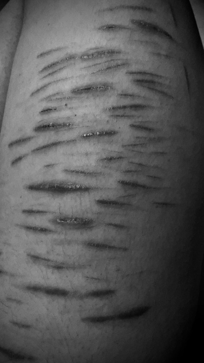 morutemortala's tweet photo. scars r so pretti :o 

SFX MAKEUP!!! NOT REAL

#988twt #ouchietwt https://t.co/Y5228wDXkH