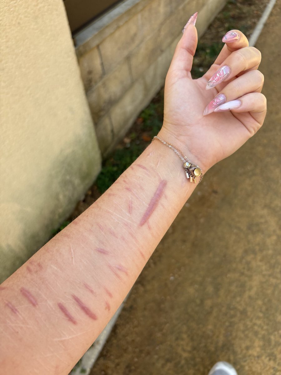 yukiwilyla's tweet photo. tw // sh , scars 

6 months clean tdayyy!! 🤍 but i was once 6 years clean so i still have a long way to go but im very proud https://t.co/BnbvqWdCVP