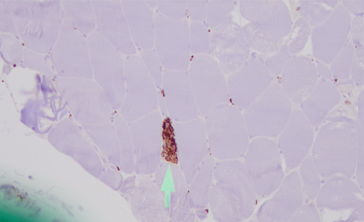 ColeBiehlDO's tweet photo. Starting neuropathology fellowship on neuromuscular + autopsy, so I’ll be sharing some muscle pathology pearls along the way.

Here’s a nice example of skeletal muscle fiber necrosis with macrophage-mediated phagocytosis. 

The arrow highlights the affected fiber on H&E, with CD68 highlighting the infiltrating macrophages.

Necrotic fibers are a nonspecific injury pattern seen in inflammatory/immune-mediated myopathies, muscular dystrophies, and toxic/metabolic injury.

More muscle pathology to come. 🔬💪