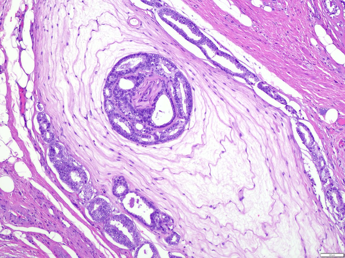 ESP_Pathology's tweet photo. 🔍Prostatic acinar adenocarcinoma involving a Pacinian corpuscle, showing both peri- and intracorpuscular growth. 

🔬Every slide deserves careful examination!
📷João Lobo, MD, PhD, Pathologist, Assistant Professor &amp; ESP Alumni, Portugal. 

#pathology #EveryDayPathology 
#PathX https://t.co/0JB5ymlZNF