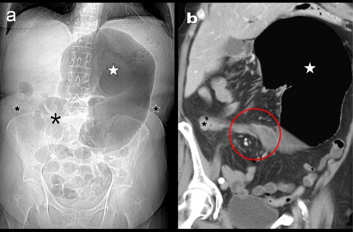 Doctors_GUILD's tweet photo. Doctor, my abdomen suddenly became massively distended

A 45-year-old patient presents with:

- Sudden abdominal pain
- Progressive distension
- Vomiting
- Obstipation

Abdominal imaging shows a massively dilated, displaced cecum.

Can you identify this surgical emergency? https://t.co/fTOEJuCfV9
