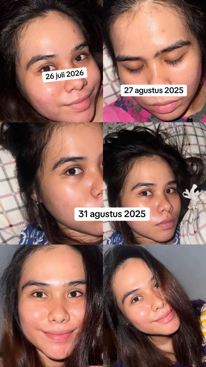 sitinabillafa's tweet photo. warga X mau cerita
yang gak suka/ jijik skip aja ya (real bareface)
acne journey kurang lebih 4 BULAN saja🫣🙏🏻tanpa TREATMENT!!#masyaAllahtabbarakallah #jerawatgone https://t.co/luUtI4IzZ1