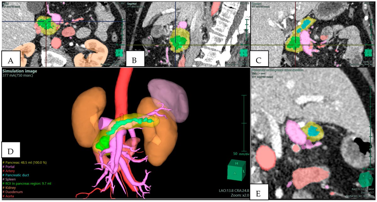 JPM_MDPI's tweet photo. ✨Call for Reading

📃Artificial Intelligence and 3D Reconstruction in Complex Hepato-Pancreato-Biliary (HPB) Surgery: A Comprehensive Review of the Literature

👨‍🔬by Andreas Panagakis et al.
🔥Article Views 1370; Citations 6
🔗https://t.co/GM7OFIYpyG

#mdpijpm @MediPharma_MDPI https://t.co/ORawKFdVa3
