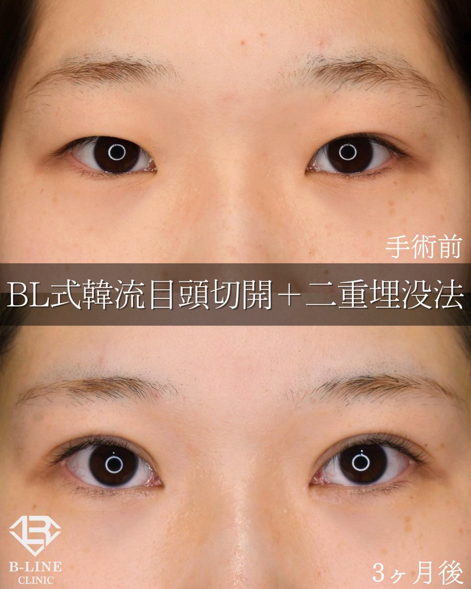 dr_koikeyasu's tweet photo. 【韓流目頭切開術+二重埋没法】
手術3ヶ月 ⭐️モニター価格15万〜⭐️

目頭切開の傷跡がどこにあるかわかりますか？
韓流目頭切開は傷跡が内眼角の内側に隠れるように切開・縫合しますので、Z形成よりもさらに傷跡を目立たなくする事ができます!
目頭は傷跡が露出し、目立ちやすい部分ですので、医師の技量により仕上がりに差が大きく出ます。
ミリ単位での調整とデザインのセンスが必須ですので、経験豊富な美容外科専門医にお任せ下さい！