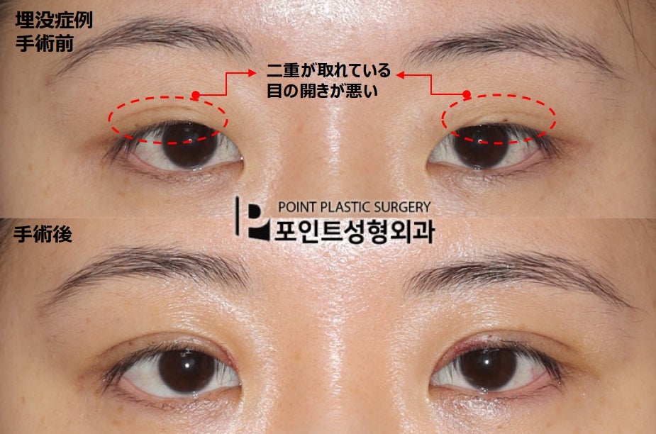 pointpsjp's tweet photo. 🏥ポイント整形外科 二重修正症例

✔二重が取れて目が開けにくい
✔眠たそうな印象

幅は大きく変えず、
目つき矯正と二重形成で
自然に目の開きや形を整えた症例です。

​🔗LINE相談はこちら：https://t.co/dxY8upynaJ
（無料・日本語OK)

#���重修正 #目の開き #渡韓整形 https://t.co/VtmCwHZZxz