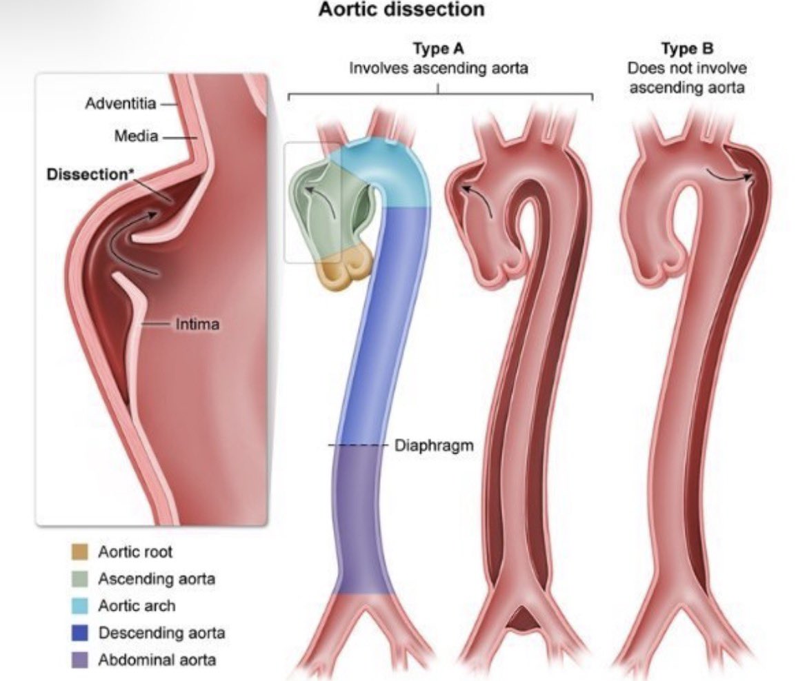 ZainKhalpey's tweet photo. Aortic dissection is a time-sensitive emergency where anatomy matters.
Type A involves the ascending aorta, while Type B does not.
Rapid recognition and appropriate management can be lifesaving.
@ClevelandClinic
#MedTwitter #AorticDissection #CardiacSurgery #Cardiology https://t.co/GlikfOlQzD