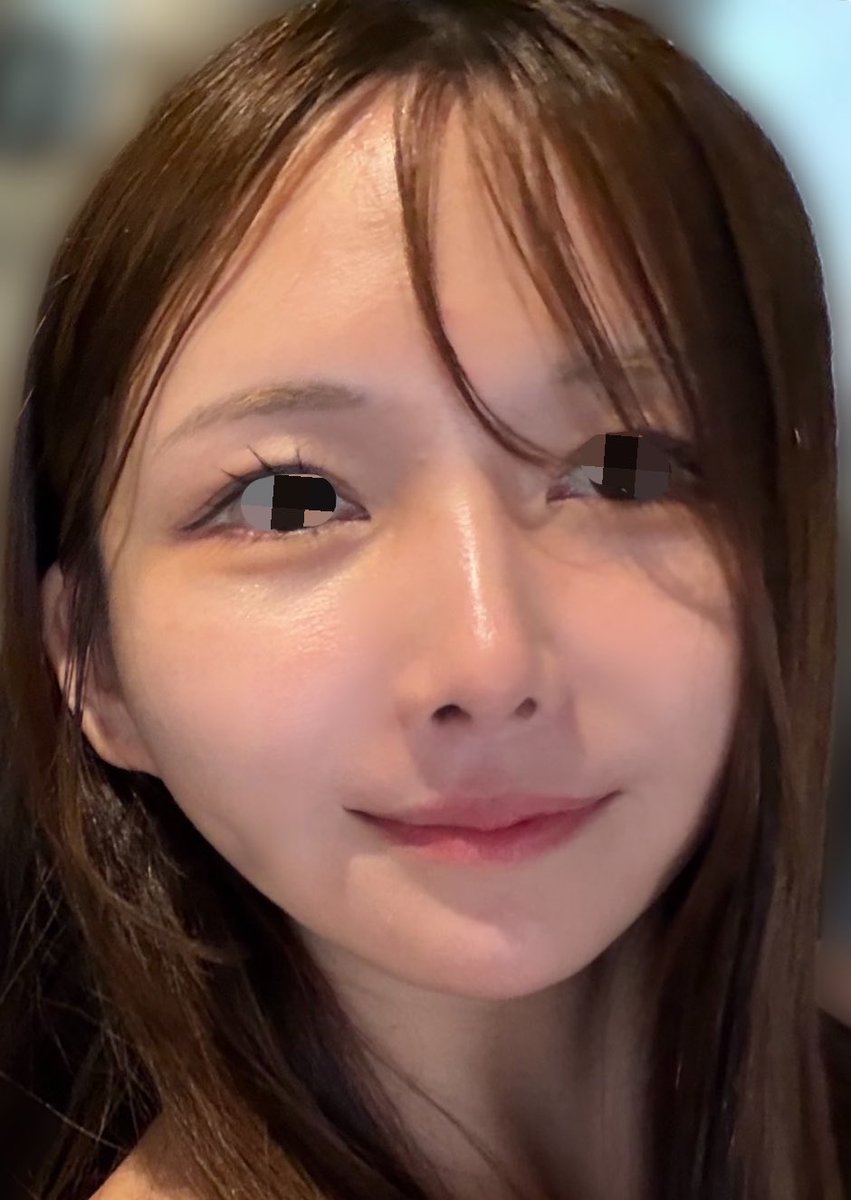 17dsy_'s tweet photo. ←21歳なのに汚肌過ぎてしんどい。　
　　　　　　　よく頑張った25歳の私→

肌治療でやったことは全てリプに書く！ https://t.co/75VQV7KsFm