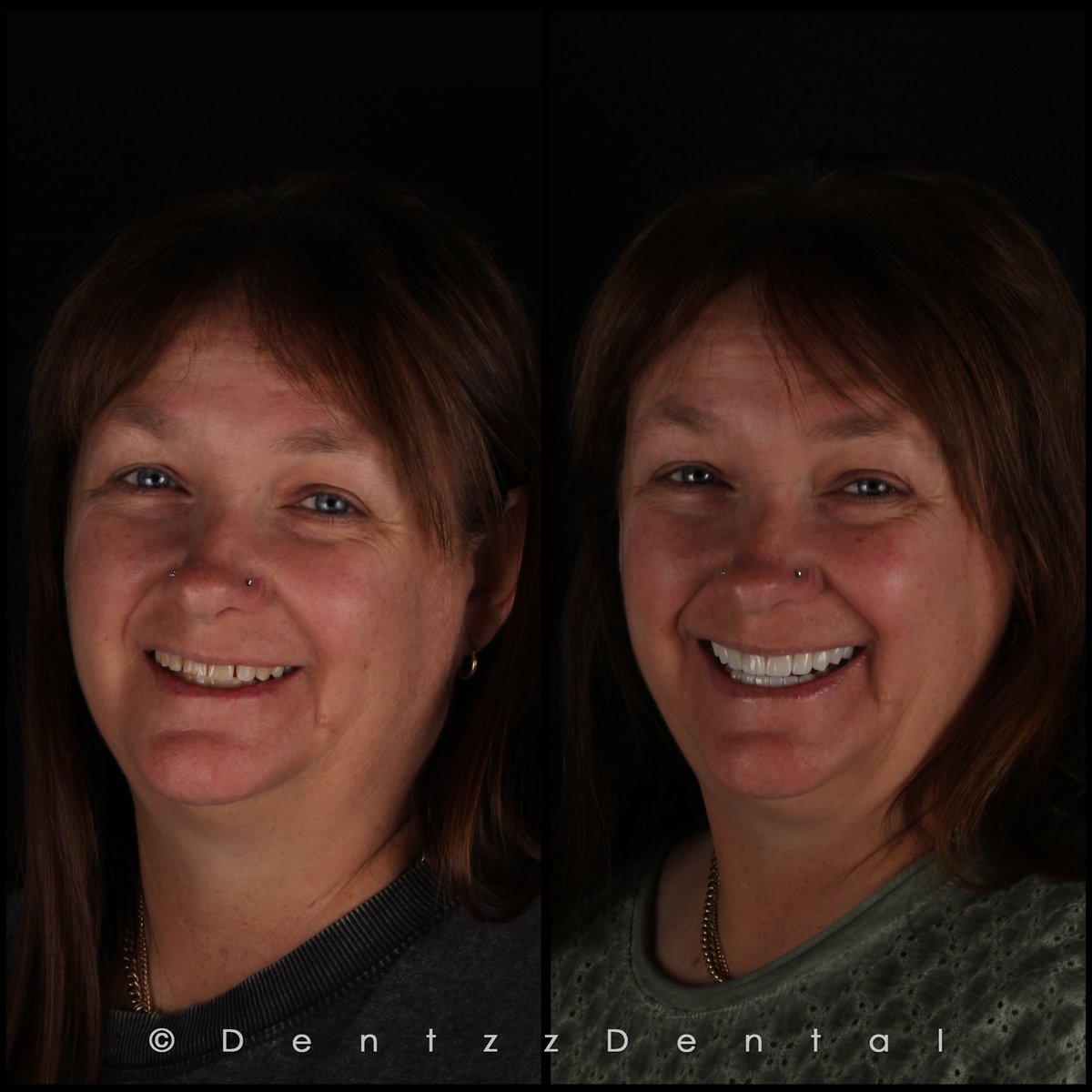 DentzzReviews's tweet photo. Dentzz Reviews | The best transformations don’t look like transformations at all, they look natural. 

Careful attention to tooth shape, alignment, and shade gave her a smile that’s brighter and more balanced, without losing what makes it hers. 
#Dentzz #DentzzReviews https://t.co/YL4N5UZSFI