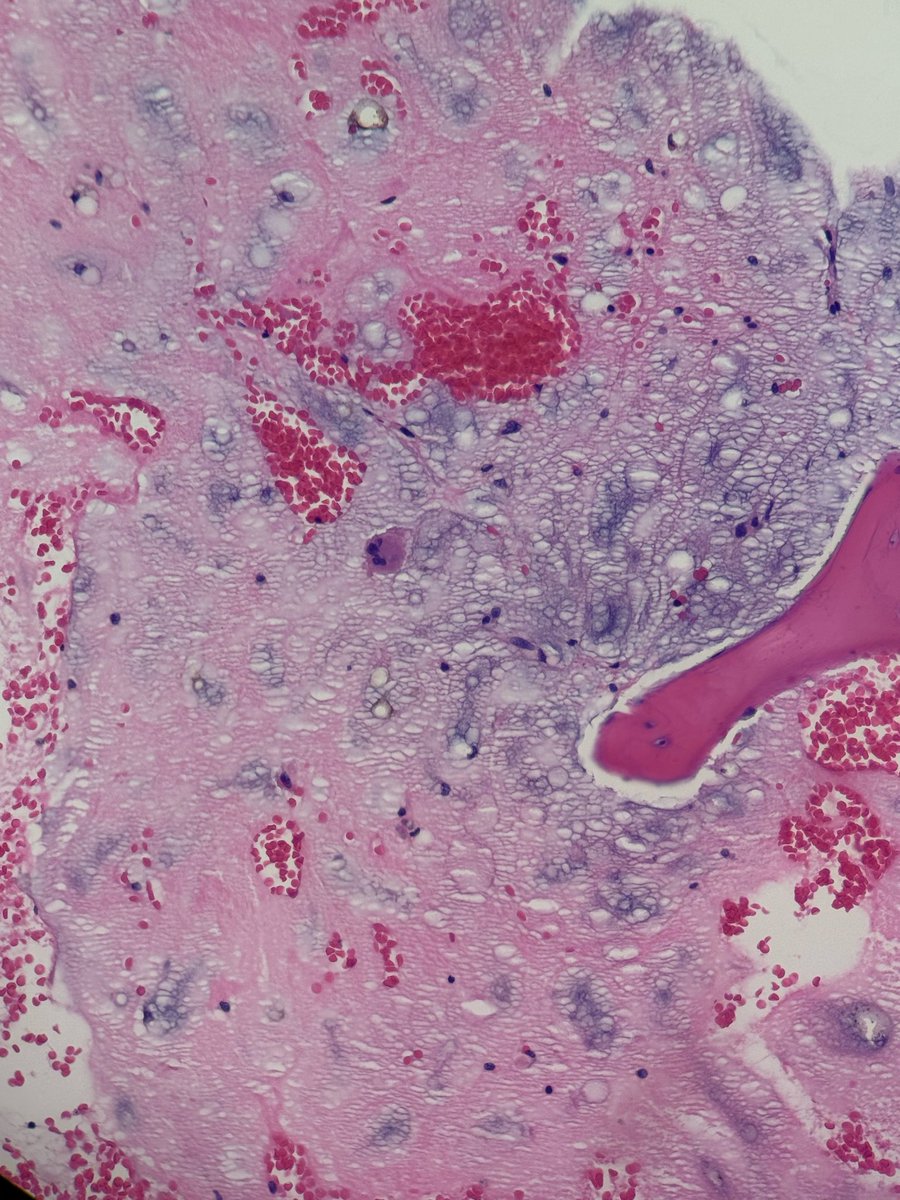 PathologyKate's tweet photo. What is the clinical history?  #BoardFodder https://t.co/zDr9PQNEsv