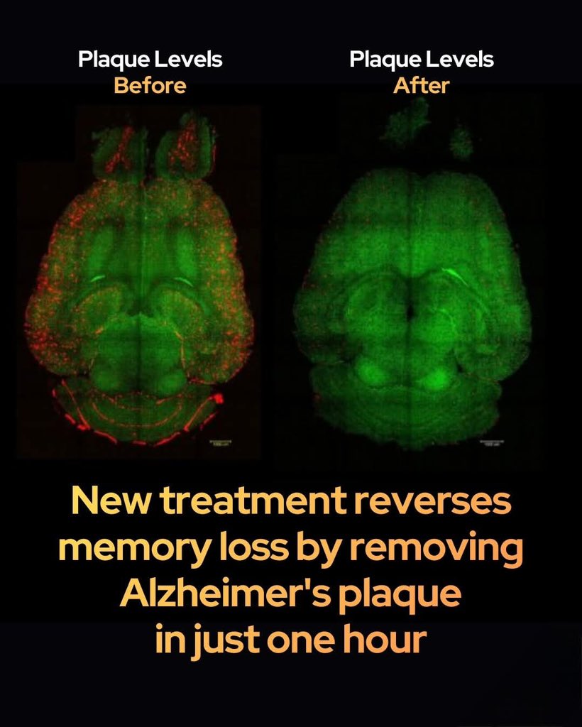 ShiningScience's tweet photo. A new treatment literally removes Alzheimer’s plaque in just one hour.

Scientists have unveiled a groundbreaking approach to treating Alzheimer’s disease using supramolecular nanoparticles that act as the medicine itself rather than just a delivery vehicle. Unlike traditional therapies that target neurons directly, these engineered particles focus on repairing the blood-brain barrier—the critical interface that regulates brain health. By mimicking natural ligands, the particles reactivate a protein called LRP1, which serves as a molecular ferry responsible for transporting toxic amyloid-beta out of the brain and into the bloodstream. In laboratory tests, just three injections reduced toxic plaque levels by up to 60 percent in as little as one hour, essentially jump-starting a stalled waste-clearance system.

The long-term cognitive impact of this treatment is even more promising for the future of dementia research. Mice at an age equivalent to a 60-year-old human regained normal behavioral patterns six months after receiving the therapy, with brain imaging revealing a dramatic decrease in amyloid plaques compared to untreated subjects. This shift toward restoring the brain's vascular function suggests that we may be able to reverse neurodegeneration by fixing the "plumbing" of the brain rather than focusing solely on the cells themselves. While human trials are still on the horizon, this innovative strategy offers a vital new roadmap for treating a disease that has long resisted conventional medical intervention.

source: UCL News. (2025). Nanoparticles Reverse Alzheimer’s Pathology in Mice. University College London.