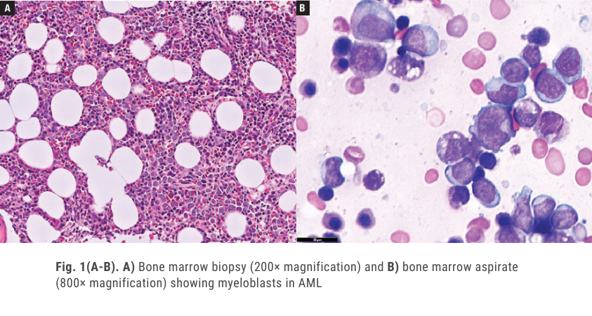 AMPath's tweet photo. A new AMP report in CAP TODAY highlights the importance of germline testing for suspected DDX41 variants, including its implications for bone marrow transplantation, and explores barriers that can prevent patients from accessing testing.

Read here: https://t.co/7nmMbWEBin https://t.co/JMmgDqcQUc