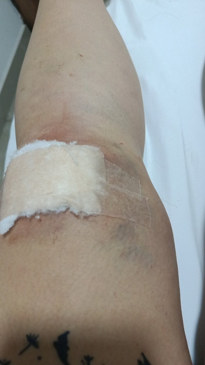 AbbyWatson8's tweet photo. Guys, I was absent for 3 months. I had a pretty bad accident where my left leg was badly injured. Now I'm doing better and getting back to squirting with my recovering leg lol #stripchat #chaturbate #white_squirt_x #white_white https://t.co/zNI1MMh7uM