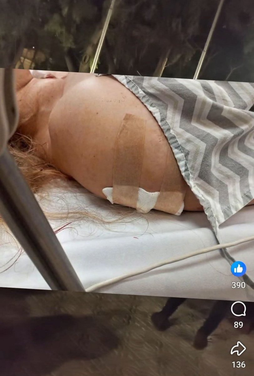arielviano's tweet photo. Qué raras son las fracturas expuestas en Bolivia y no hablemos de tres tiros en el pecho. https://t.co/RxxRxCW77C
