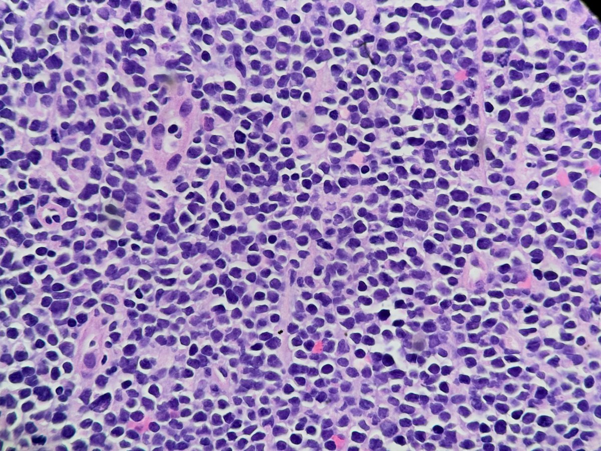 PathologyKate's tweet photo. CD19 is also positive. What cytogenetic findings indicate a good prognosis?
#BoardFodder https://t.co/4bHqfTrWVU