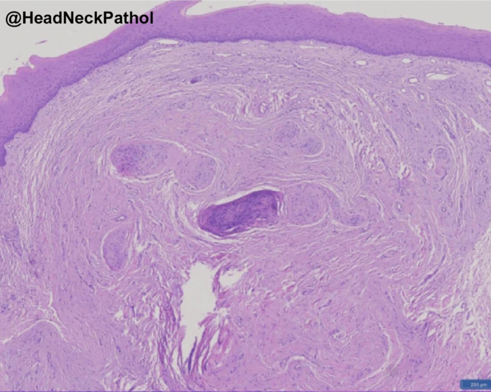 HeadNeckPathol's tweet photo. Expanding the Histologic Spectrum of Oral Pseudoperineurioma: A Retrospective Study of 21 Cases
Hisham Alshuaibi, Shamim Neduvanchery, Sarah G Fitzpatrick &amp; Indraneel Bhattacharyya
https://t.co/QskISiuQlS
#HeadNeckPathol #HNPJ #HeadandNeckPath #Pathology #ENTPath #PathologyTweet https://t.co/w3Ijig3RWm