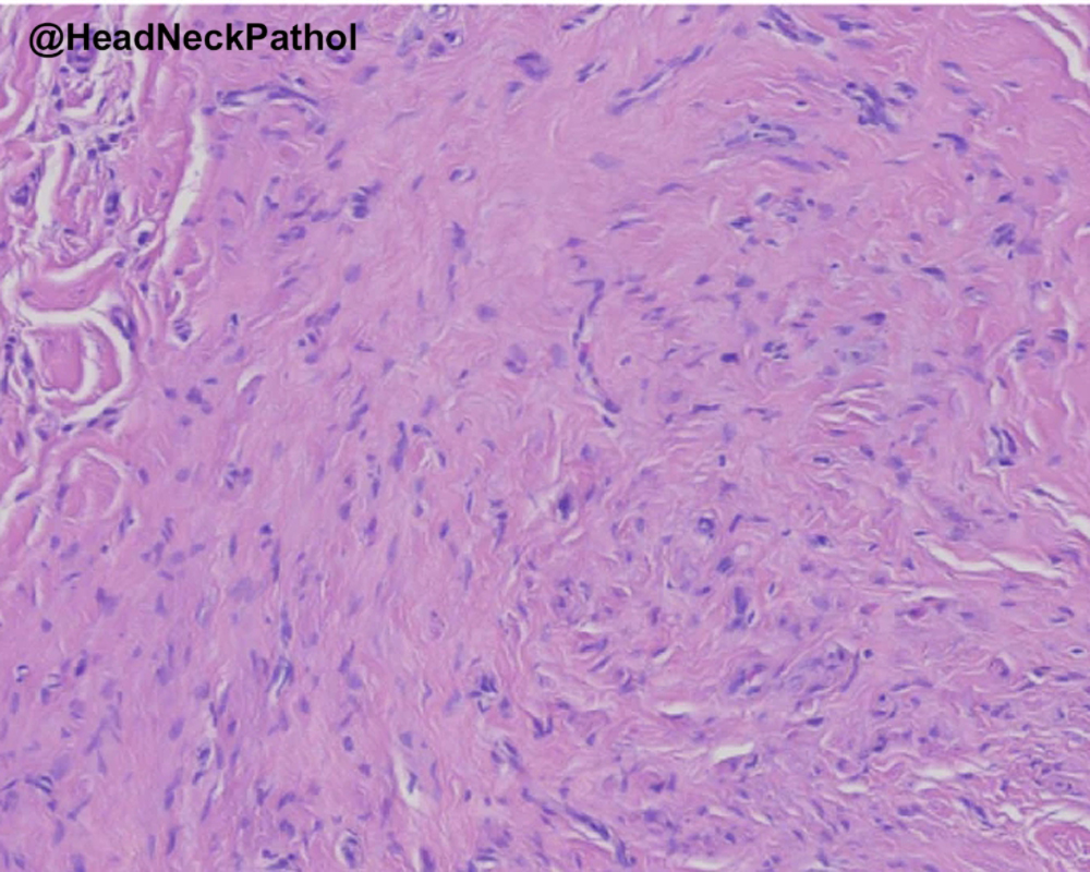 HeadandNeckPath's tweet photo. Expanding the Histologic Spectrum of Oral Pseudoperineurioma: A Retrospective Study of 21 Cases
Hisham Alshuaibi, Shamim Neduvanchery, Sarah G. Fitzpatrick &amp; Indraneel Bhattacharyya
https://t.co/4IWynyBWm7
#HeadNeckPathol #HNPJ #HeadandNeckPath #Pathology #ENTPath #PathologyTweet https://t.co/Y9ohv26f8i