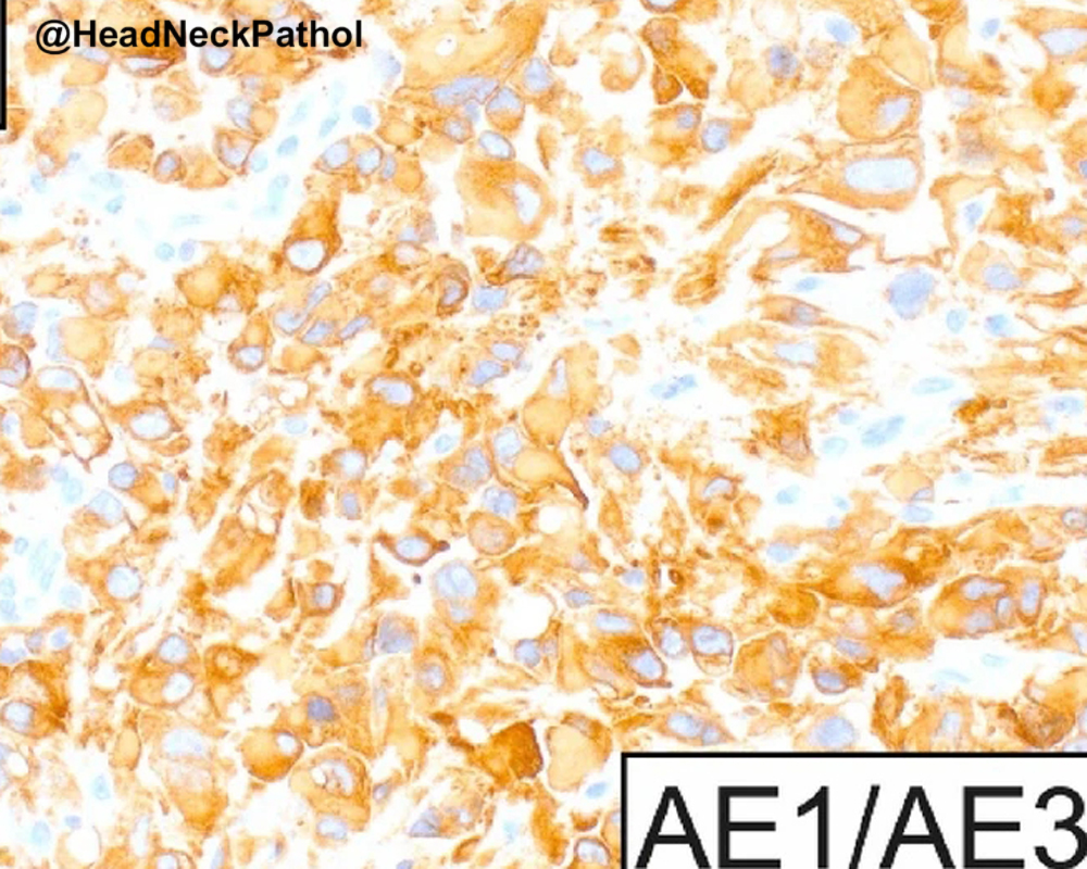 HeadNeckPathol's tweet photo. Epithelioid Sarcoma of the Oral Cavity: A Multi-institutional Clinicopathologic & Immunophenotypic Characterization of Five Cases & Comprehensive Literature Review
Argyris et al
https://t.co/xN4bhG1RkB
#HeadNeckPathol #HNPJ #HeadandNeckPath #Pathology #ENTPath #PathologyTweet https://t.co/WD1PYxRVI8