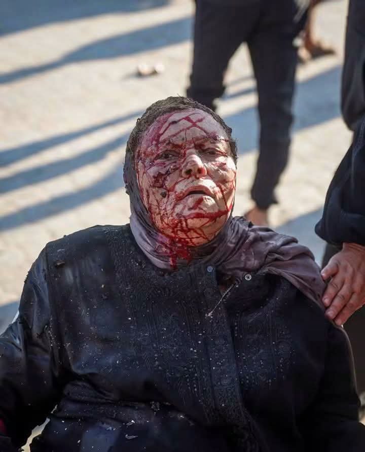 family_maya's tweet photo. الأم التي هزت صورتها العالم قبل ثلاث ايام بعد إصابتها في ميناء غزة ،وانتشرت صورتها على نطاق واسع، تناشد العالم بعد أن بترت يداها، وتوزعت الشظايا في أنحاء جسدها، وتطالب بفرصة للعلاج خارج غزة ،بعدما عجزت الإمكانات الطبية داخل القطاع عن توفير العلاج لها💔💔

#هولوكست_غزة https://t.co/LYMmuCBSx0