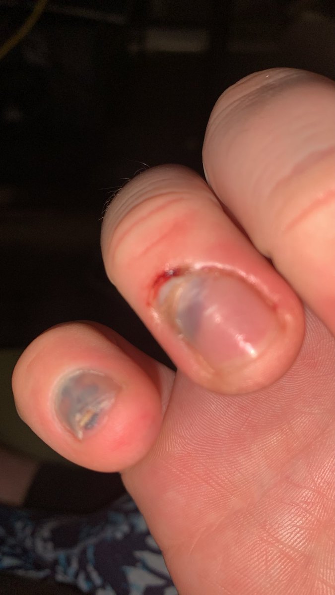 wraithenvaen's tweet photo. dropped 45’s on my fingers💔💔 https://t.co/FkG6a8tuWk