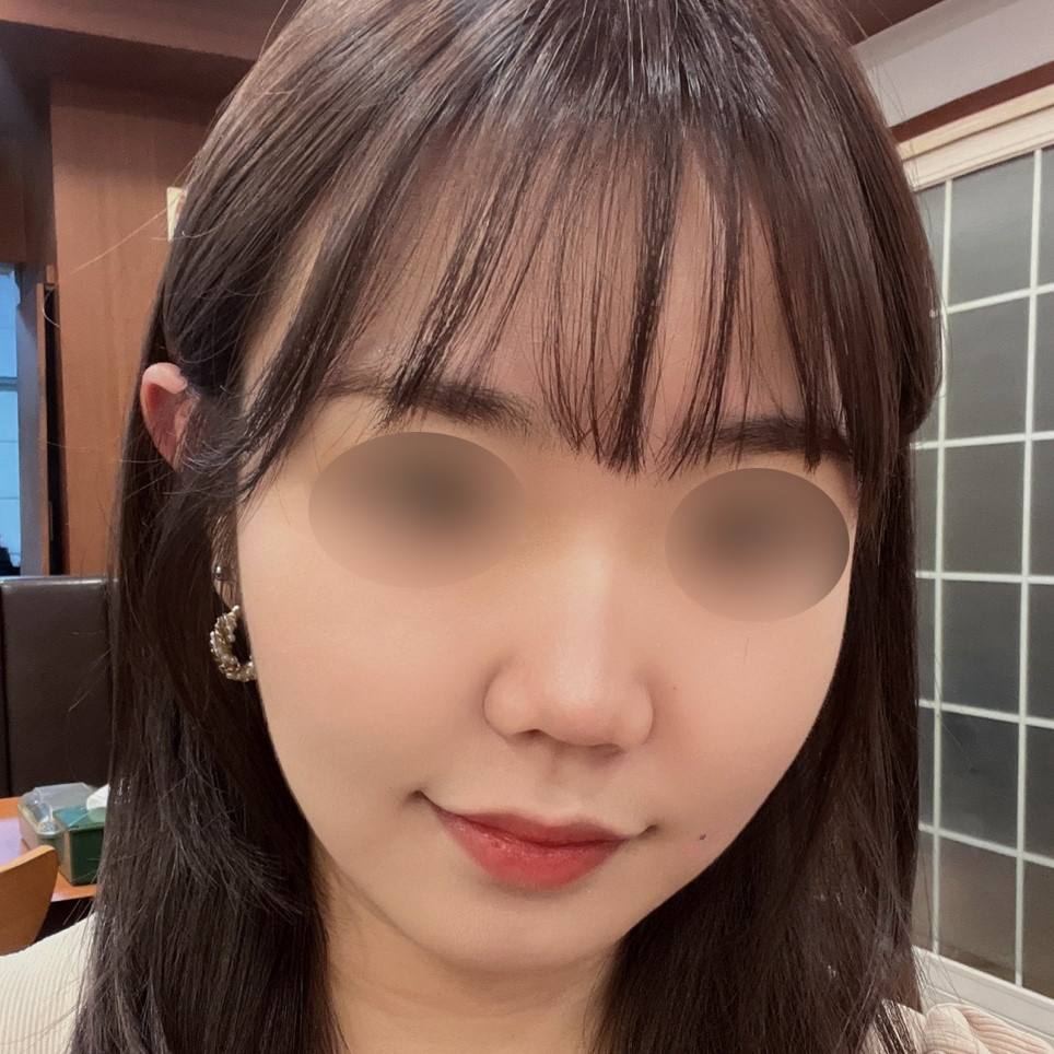 ockiha's tweet photo. 매부리 복코 긴코 같이 교정한 지 벌써 반년 됐다요 ,,
코수술 선배님 계신가욤 저는 이제 거의 제 코 같긴 한데 그래두 조심할게 있는지 !? 궁금한뎁쇼 ㅠㅠ
처음엔 고칠게 많아가지구 걱정했는데 칭구들도 수술 티 안 나게 예뻐졌다고 해줘서 만족중 ,,,🩷🩷 https://t.co/zZP0PlrHso