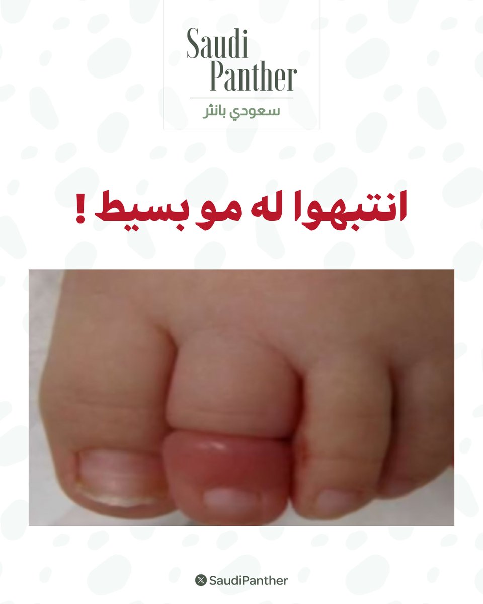 saudipanther's tweet photo. انتبهوا له مو بسيط !

تلتف شعرة أو خيط بإحكام حول إصبع القدم

وأحيانا إصبع #اليد أو الأعضاء التناسلية وينتج عن ذلك ألم وتورم في الجزء المصاب https://t.co/SDlXNJ8KcC