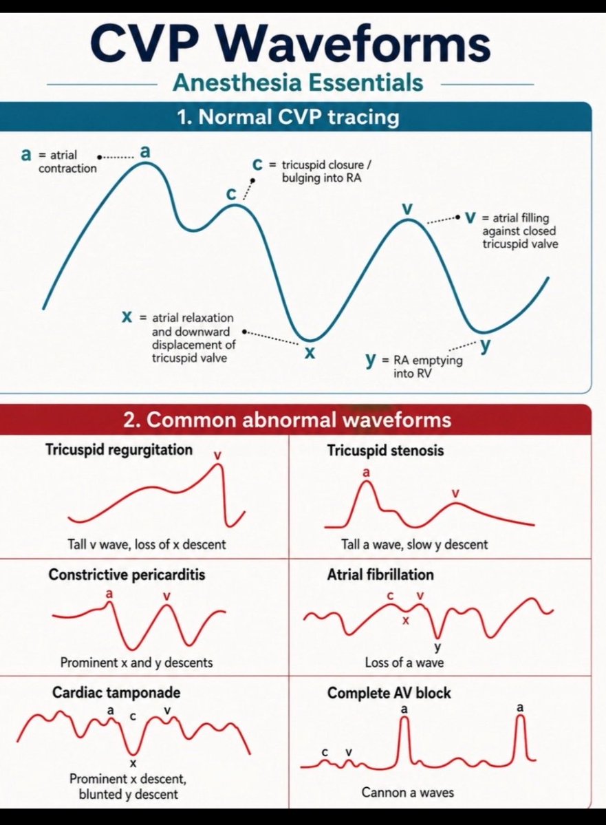 DrCriticalCare's tweet photo. Paciente PosQx de Cx Cardiaca : en anestesia cardiovascular monitorizaron la PVC !!!
Que es más rápido en UTIC ? Conectar el transductor al catéter de la PVC ? O traer el eco para valorar como ingresa a UCI ? 
- si ya lo tienes ahí … revísalo y monitoriza rápido … 
Es más rápido conectar un transductor a esperar el eco !!! Ya con calma le harás el eco y harás mediciones etc …