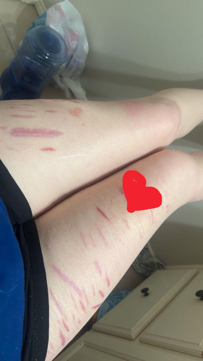 Rileys_path's tweet photo. It is screaming at me from the grave to revive it please revive me relapse relapse relapse relapse do it do it do it do it 
#sharmtwt    ( all healed scars :p) https://t.co/rzksLjVSG7