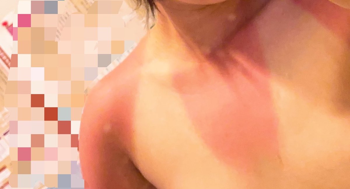 gy_wfh's tweet photo. 海行ったら焼けすぎね？？ https://t.co/z9Hi3jn7jO