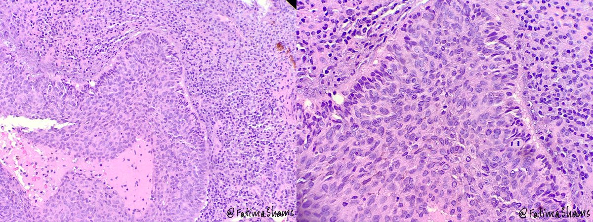 FatimaShamsPath's tweet photo. 👉A 51 YO man with long-standing, sun-exposed scalp lesion presents with recent discharge. 

What is your diagnosis❓
What IHCs may help you in ruling out the differentials❓

 #Dermatopathology #SkinPathology  #DiagnosticPitfall #DermatopathologyCase #pathology #pathtwitter https://t.co/IgJWbmChwQ