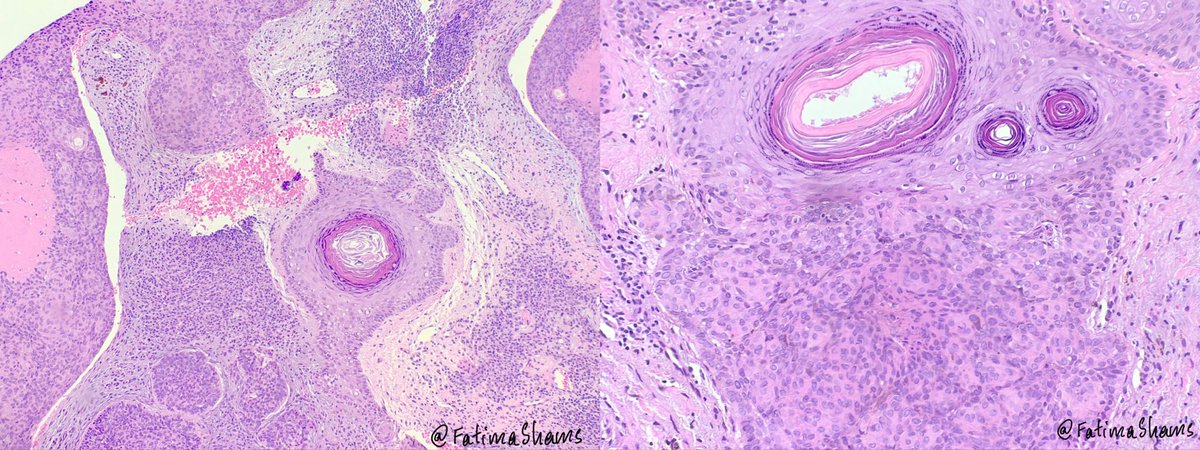 FatimaShamsPath's tweet photo. 👉A 51 YO man with long-standing, sun-exposed scalp lesion presents with recent discharge. 

What is your diagnosis❓
What IHCs may help you in ruling out the differentials❓

 #Dermatopathology #SkinPathology  #DiagnosticPitfall #DermatopathologyCase #pathology #pathtwitter https://t.co/IgJWbmChwQ