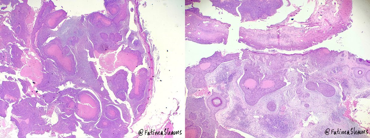 FatimaShamsPath's tweet photo. 👉A 51 YO man with long-standing, sun-exposed scalp lesion presents with recent discharge. 

What is your diagnosis❓
What IHCs may help you in ruling out the differentials❓

 #Dermatopathology #SkinPathology  #DiagnosticPitfall #DermatopathologyCase #pathology #pathtwitter https://t.co/IgJWbmChwQ