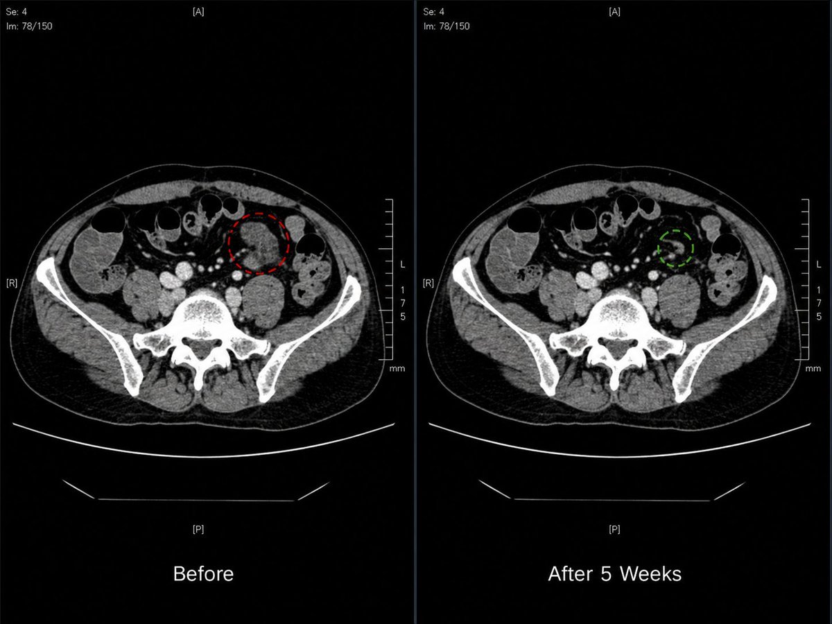 StevenHopkinsMD's tweet photo. My dad was dying. Then he wasn't.
68 years old. Retired farmer. Colon cancer.

The scans were ugly. The doctors looked grim.

I didn't accept that.

I put together a protocol from what I learned here:

72mg Ivermectin – daily

444mg Fenben

4,000mg Vitamin C

32oz Hibiscus tea https://t.co/wDk2Gch3MA